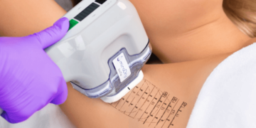 miraDry The Latest Reviews to an Innovative Approach for Underarm Sweat Reduction